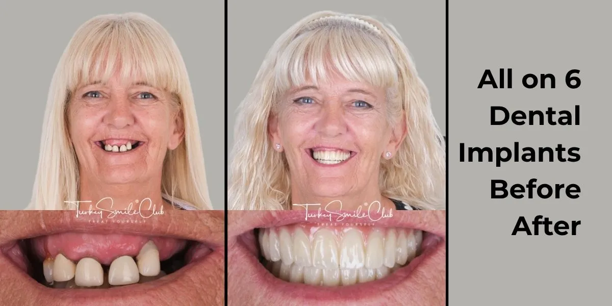 All on 6 dental implants before and after in Antalya