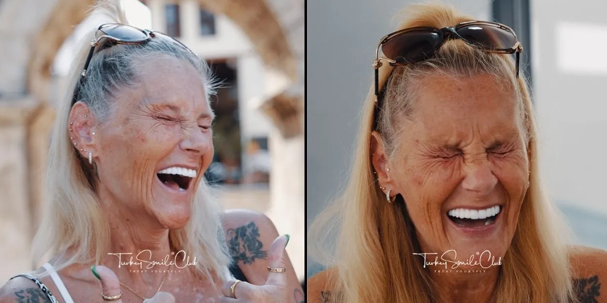 All on 6 dental implants in Antalya