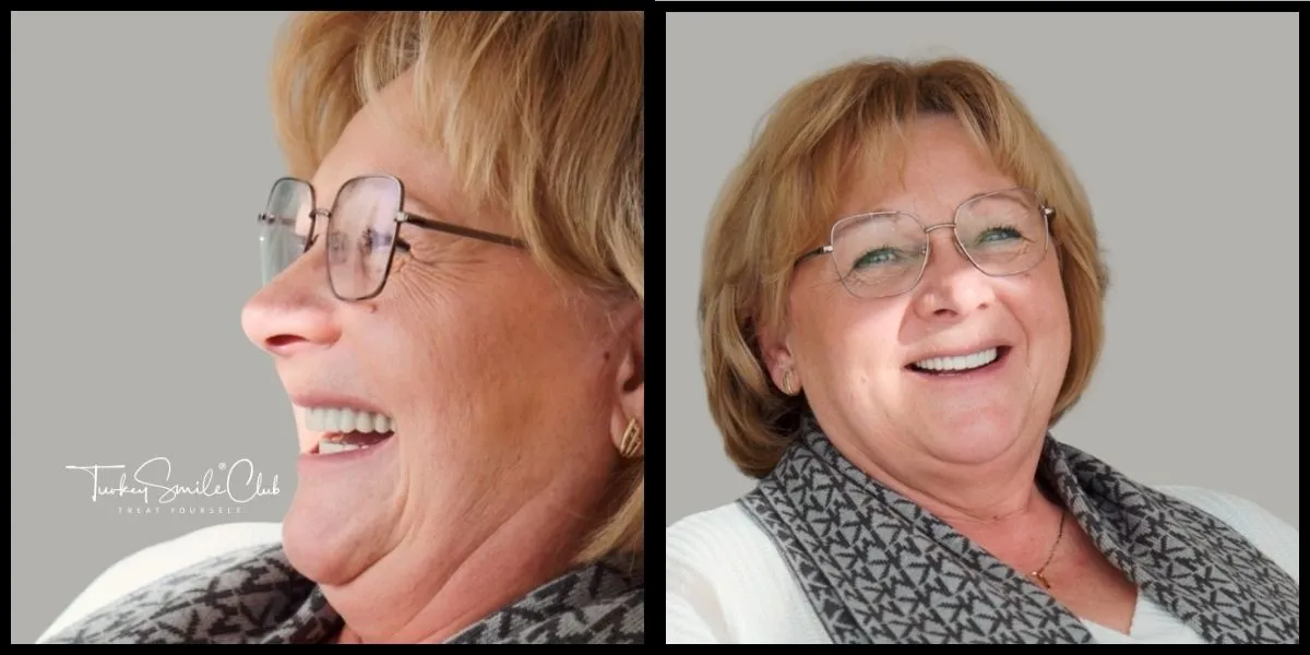 All on 6 dental implants before and after