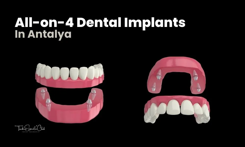 Antalya All on 4 dental implants