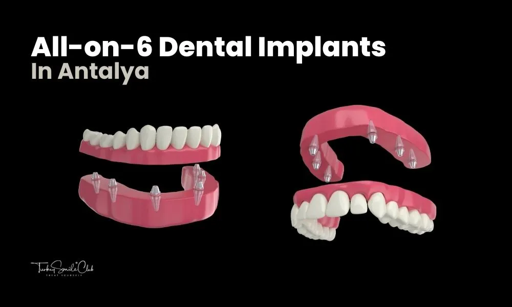 Antalya All on 6 dental implants