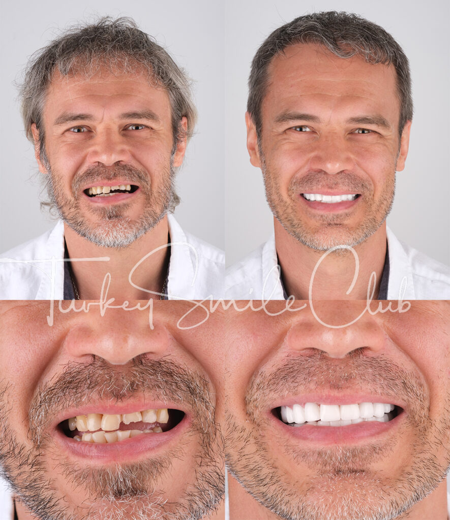 Zirconia crown in Antalya