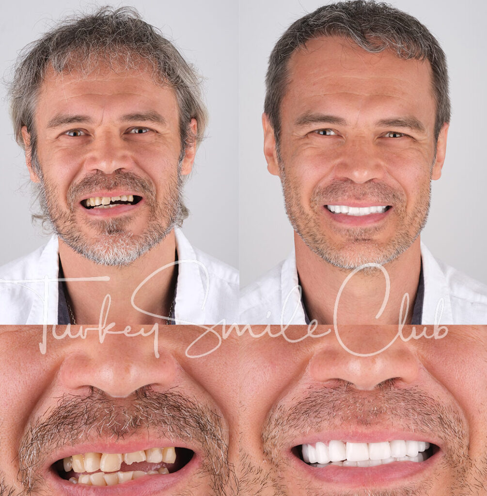 Zirconia crown in Antalya