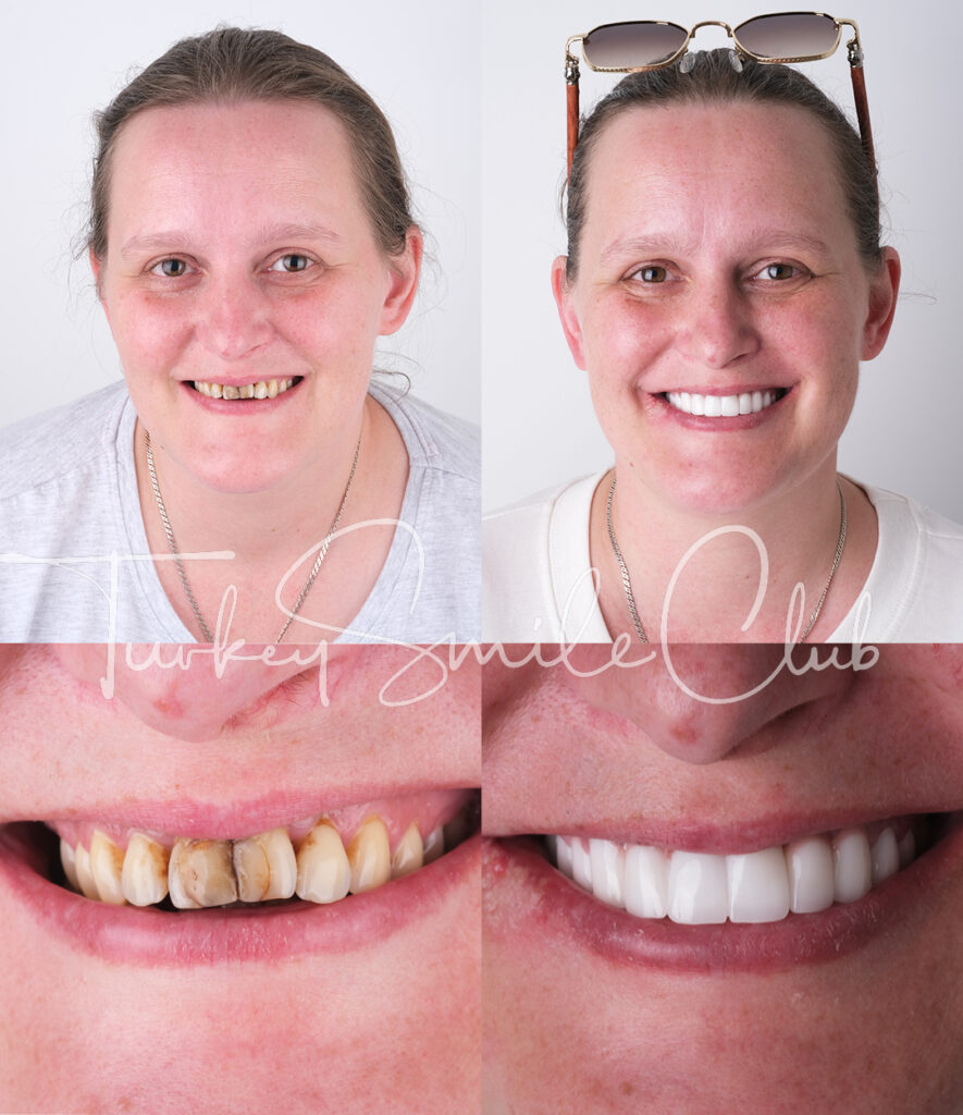 zirconium crowns Turkey