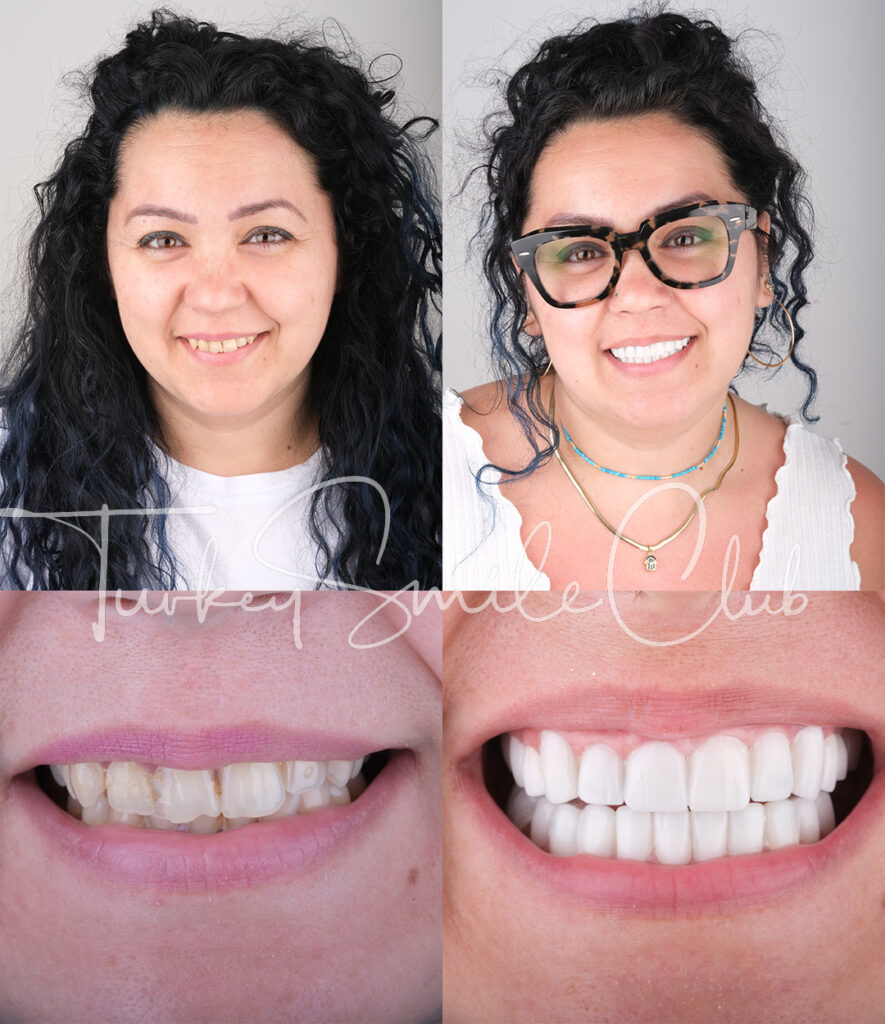 emax veneers pros and cons
