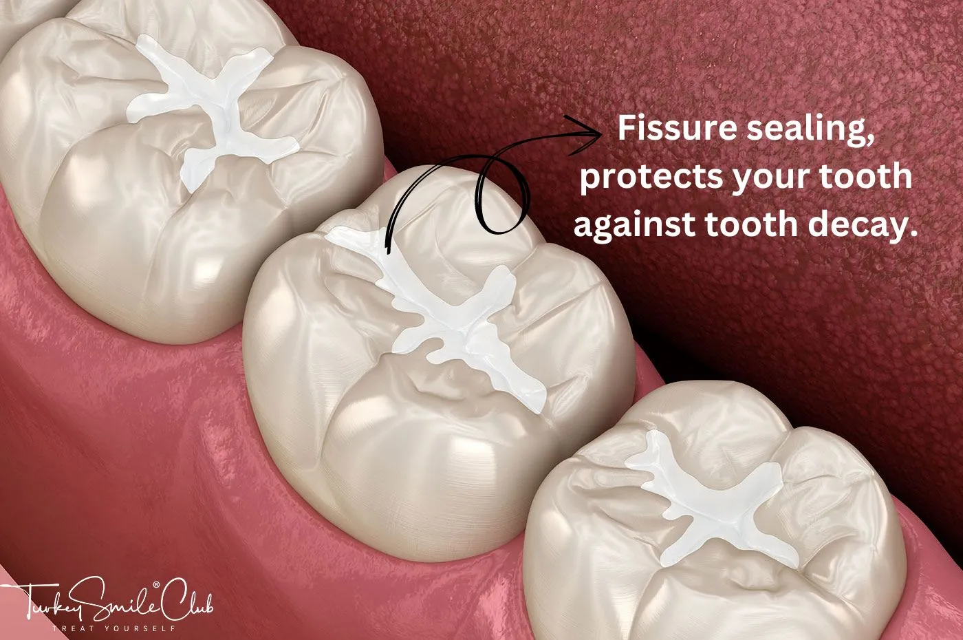 Fissure Sealing Turkey