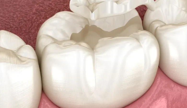 Can White fillings be whitened?