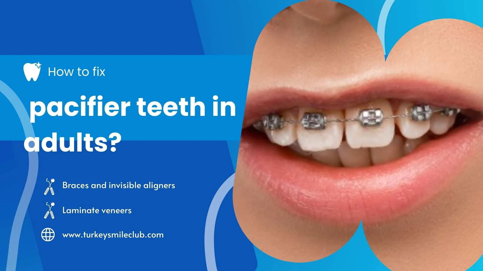 Pacifier teeth in adults