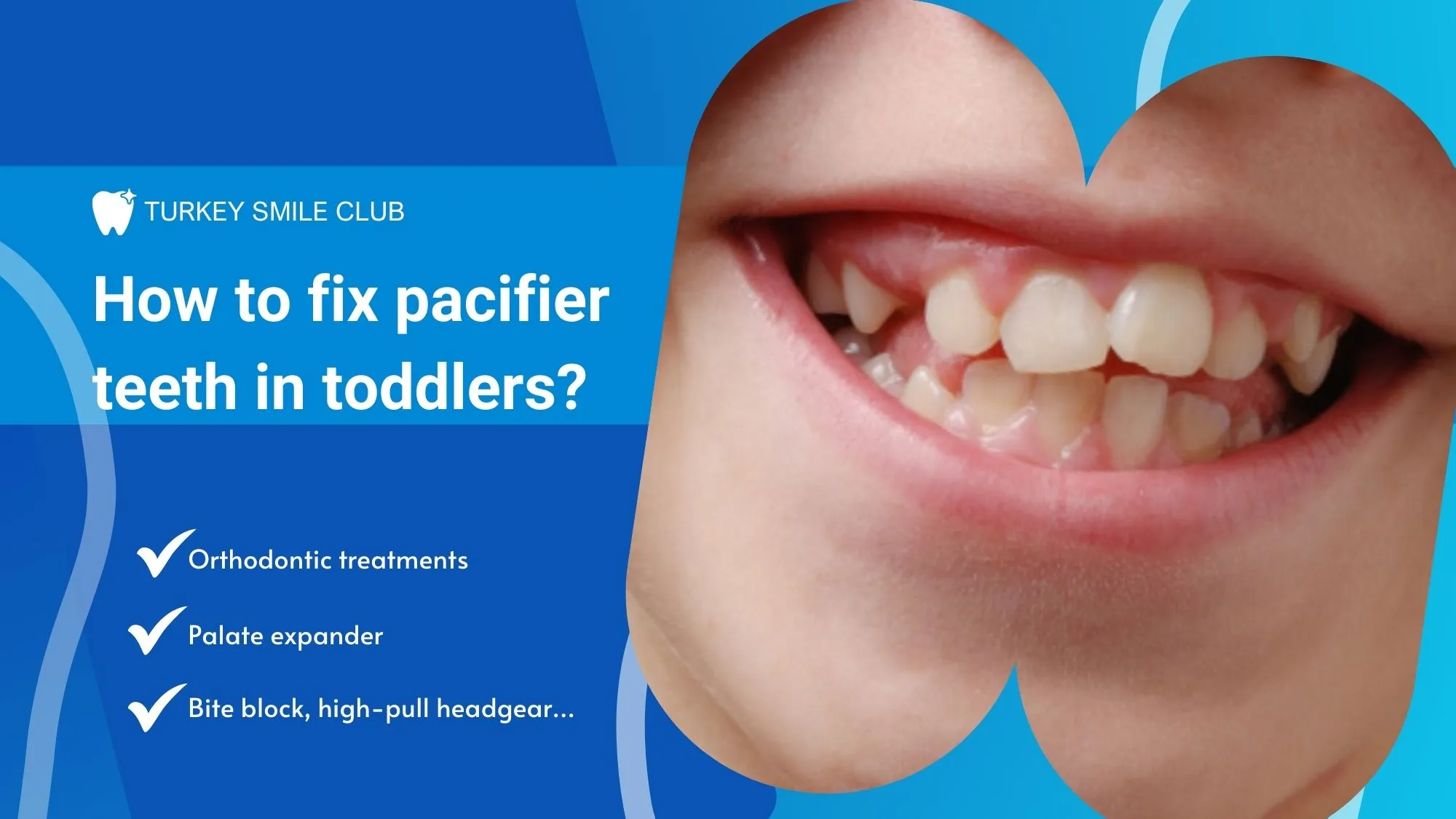 how to fix pacifier teeth in toddlers