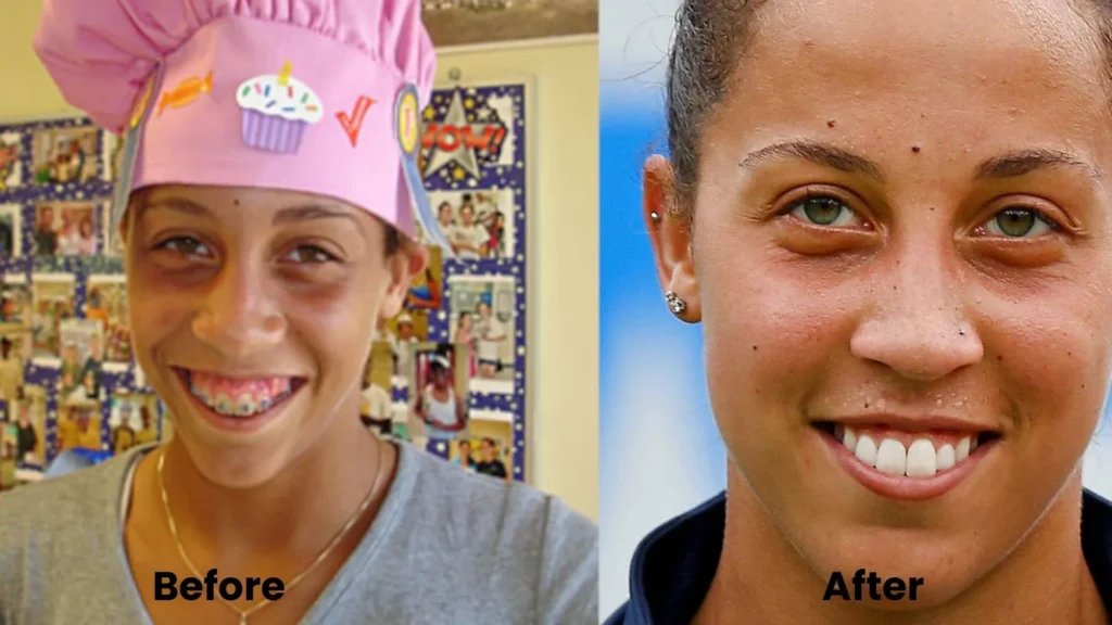 Madison Keys’ teeth:Before and after