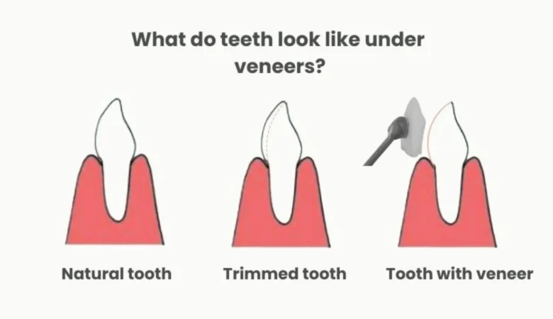 What Do Teeth Look Like Under Veneers?