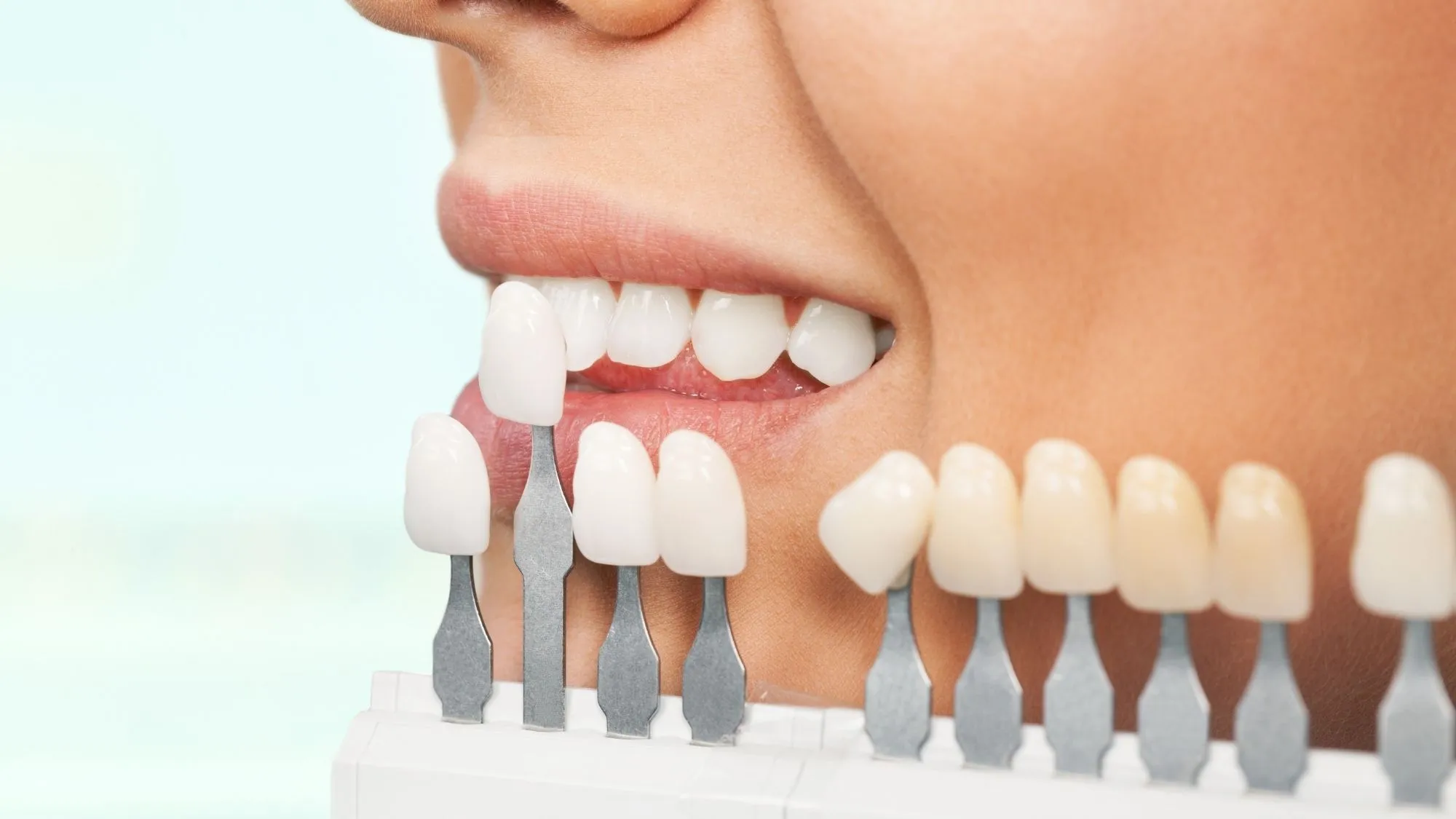 Dental veneers vs laminates