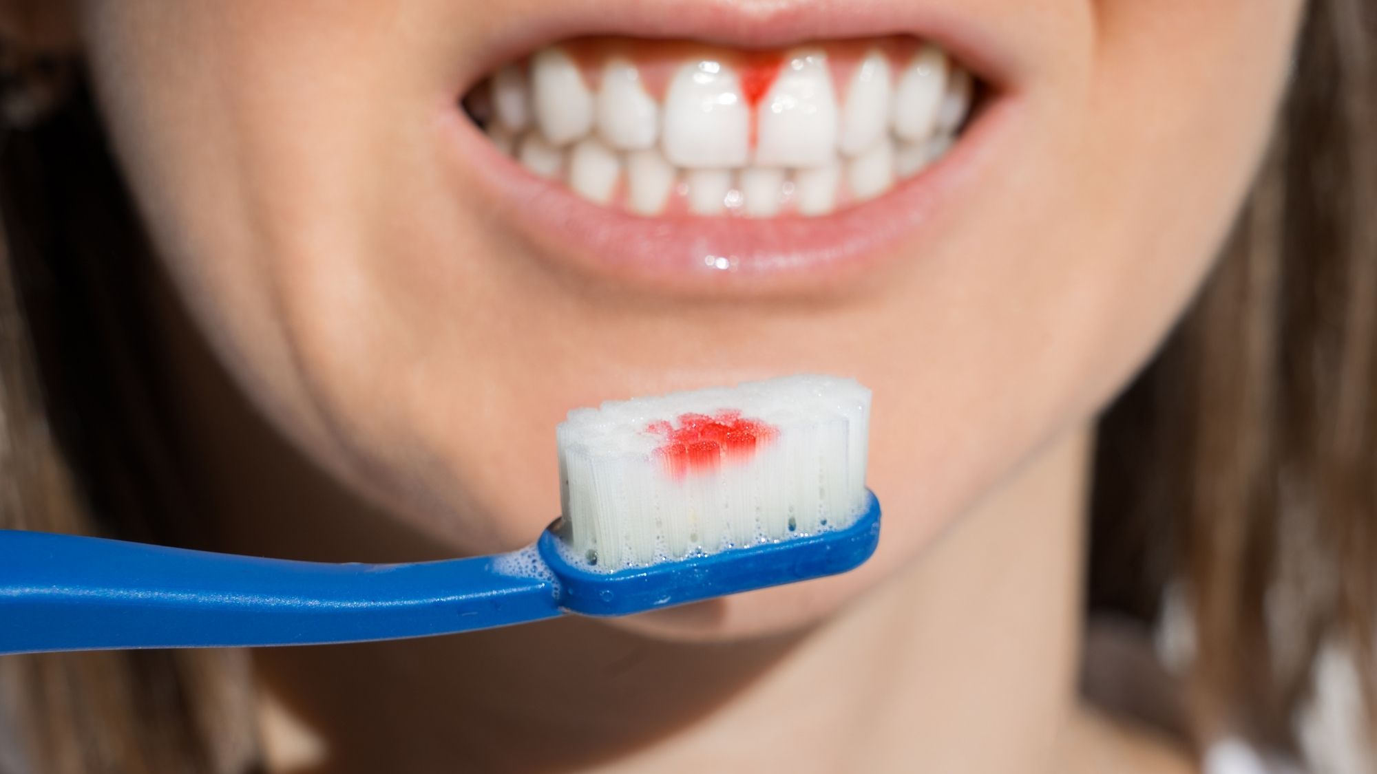 Gum disease with veneer