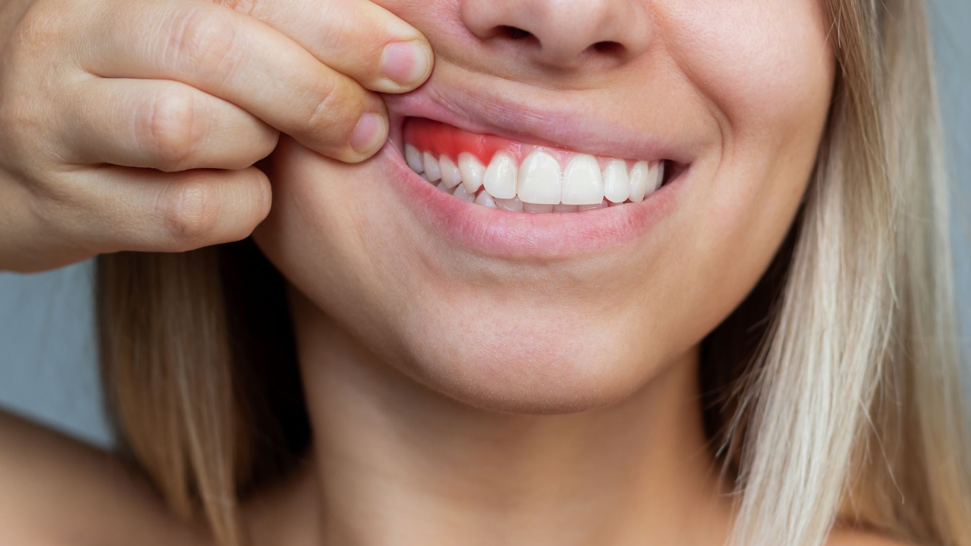 Can I get Turkey teeth with gum disease