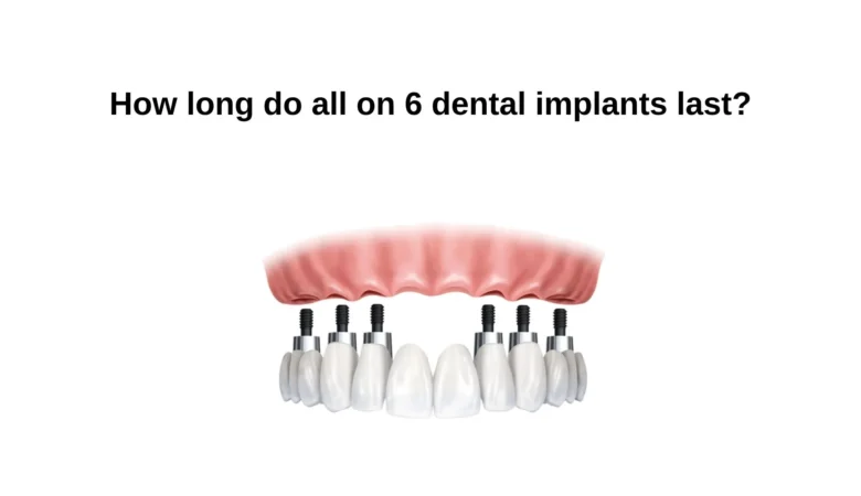 How Long Do All on 6 Dental Implants Last?