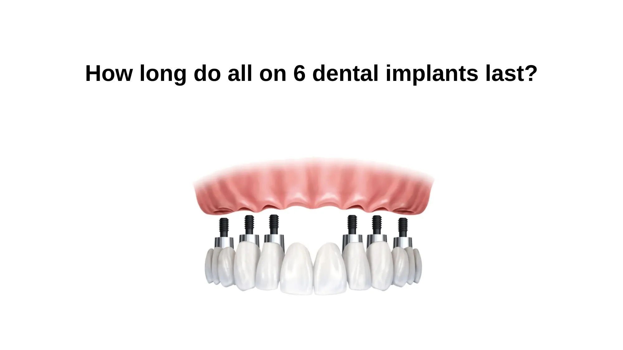 How Long Do All on 6 Dental Implants Last?