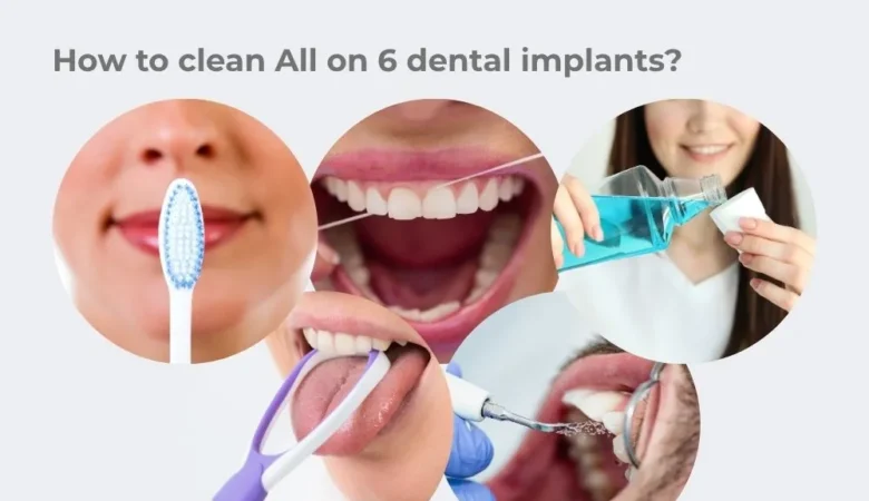 How to Clean All on 6 Dental Implants?