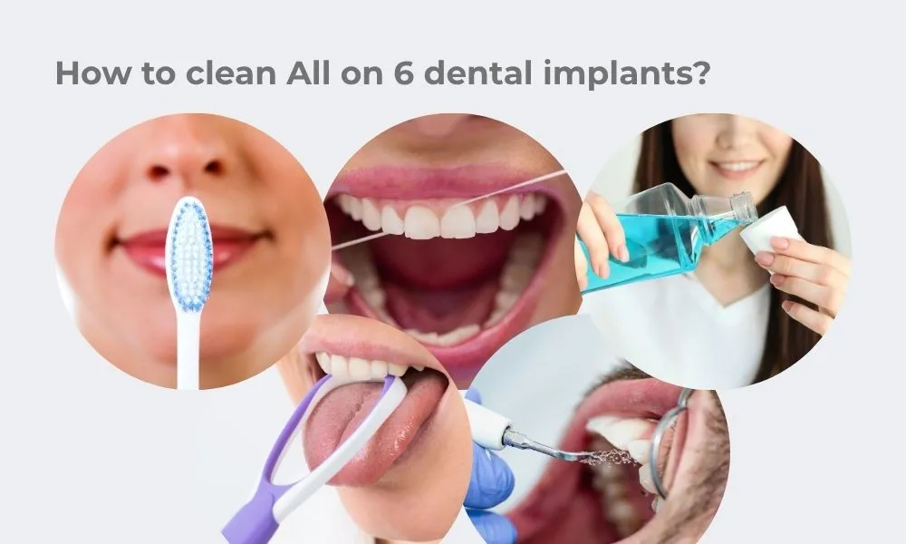 How to Clean All on 6 Dental Implants