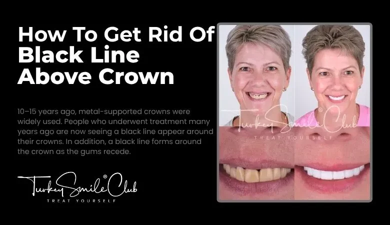 How To Get Rid Of Black Line Above Crown