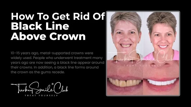 Black line above crown