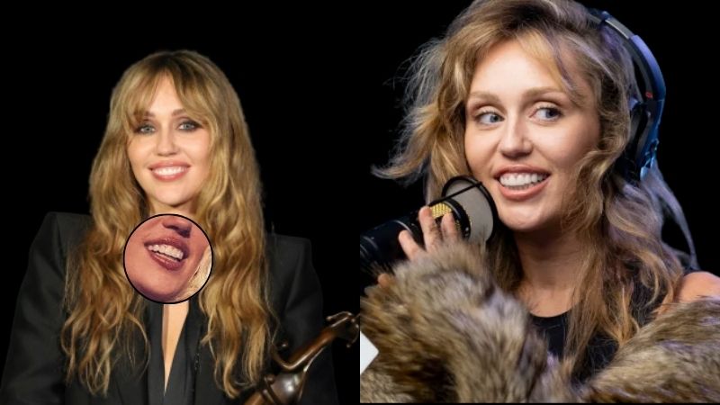 Miley Cyrus teeth veneers
