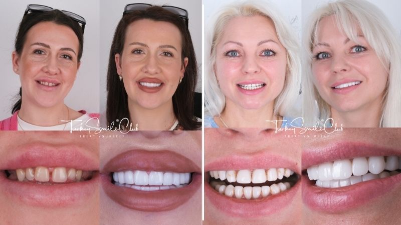 Emax veneers before and after