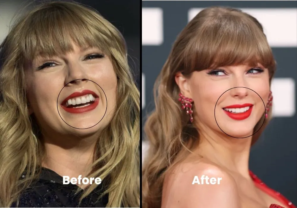 Taylor Swift teeth before after